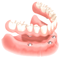Teeth in a Day San Francisco Bay Area