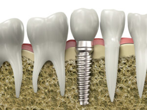 Multiple Teeth Replacement via Dental Implants