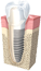 Dental Implant / Teeth in a Day (San Francisco)