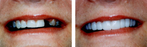 Dental Implant Smile Gallery