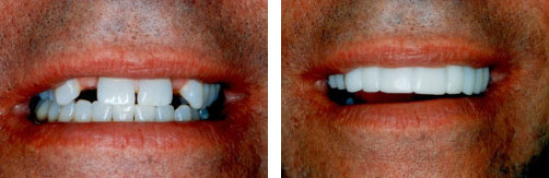 Dental Implant Smile Gallery