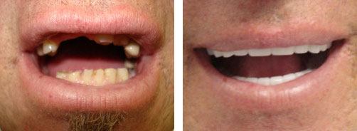 Dental Implant Smile Gallery
