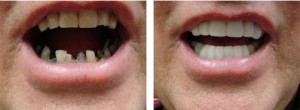 Dental Implants, Dentists & Haight Ashbury of San Francisco