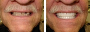 dental implants in San Francisco & second opinion issues