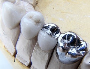 Affordable SF dental implants.