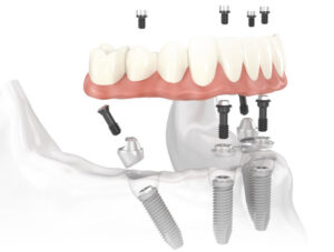 All on Four Dental Implants