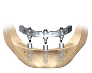 Trefoil Dental Implants in San Francisco