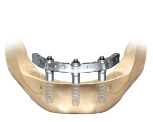 dental implant reviews in San Francisco
